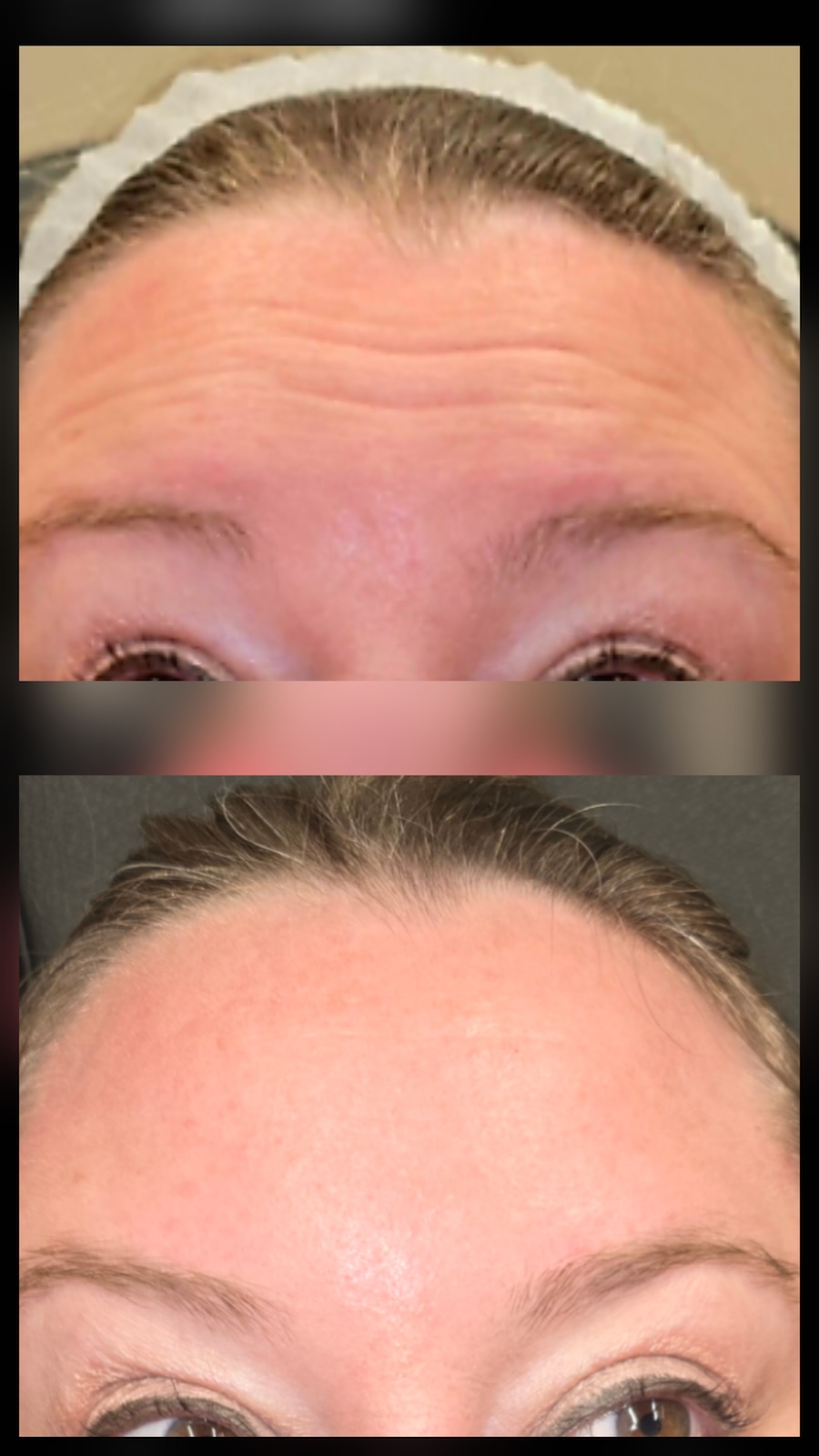 Botox