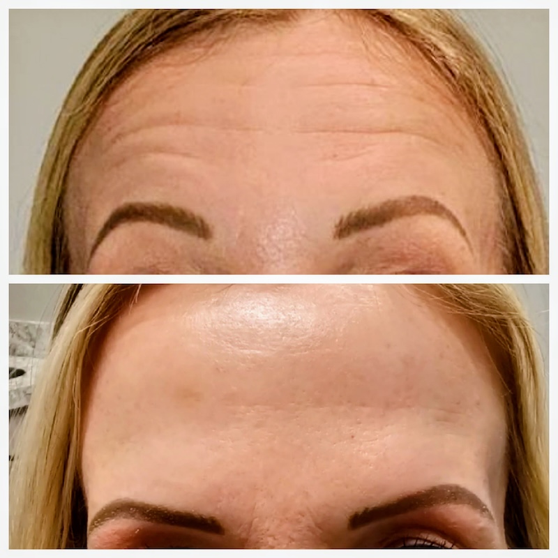 Botox Forehead