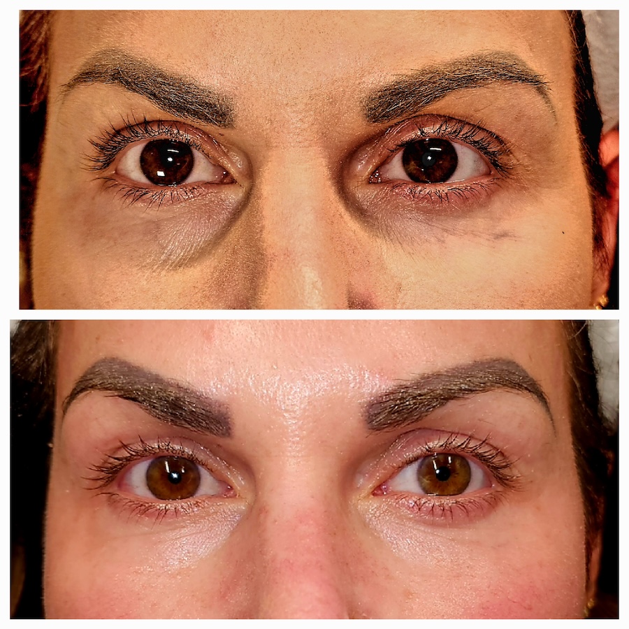 Fotona Smooth Eye 2
