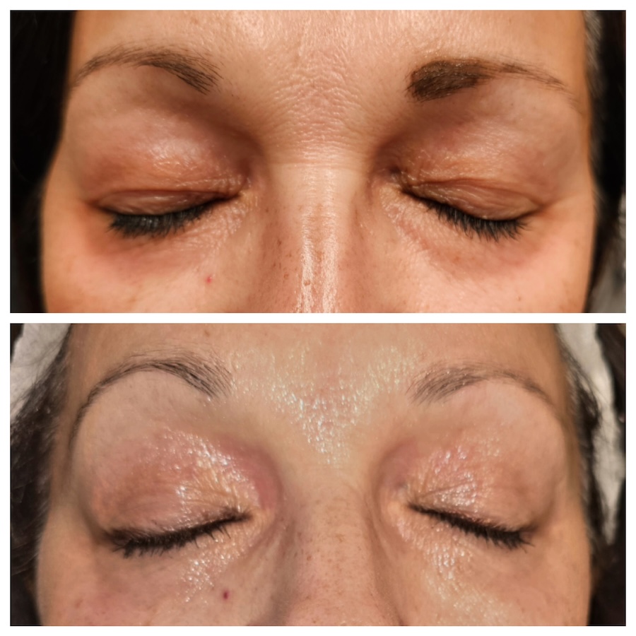 Fotona Smooth Eye