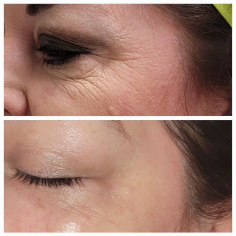 Fotona Smooth Eye 3