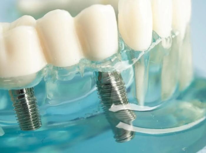 All-on-X Dental Implants: A Comprehensive Solution for Full Arch Restoration