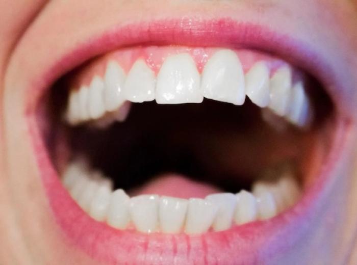 Gum Recession: Causes, Consequences, and Solutions